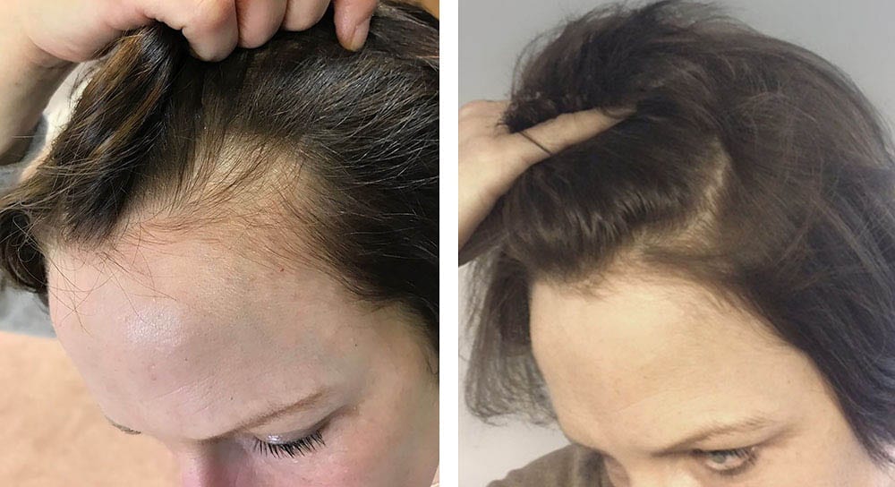 Hair restoration Results for Adeline