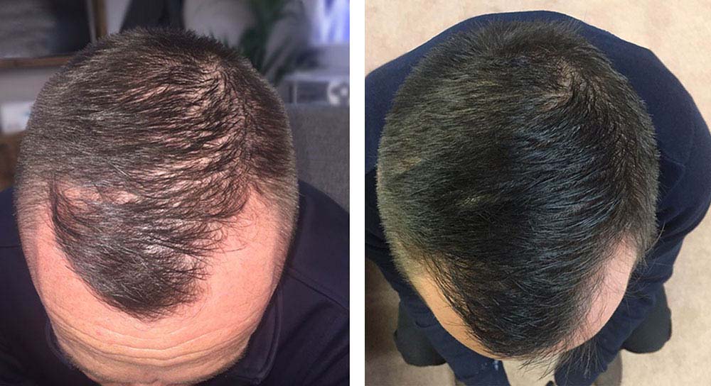 Hair transplant results