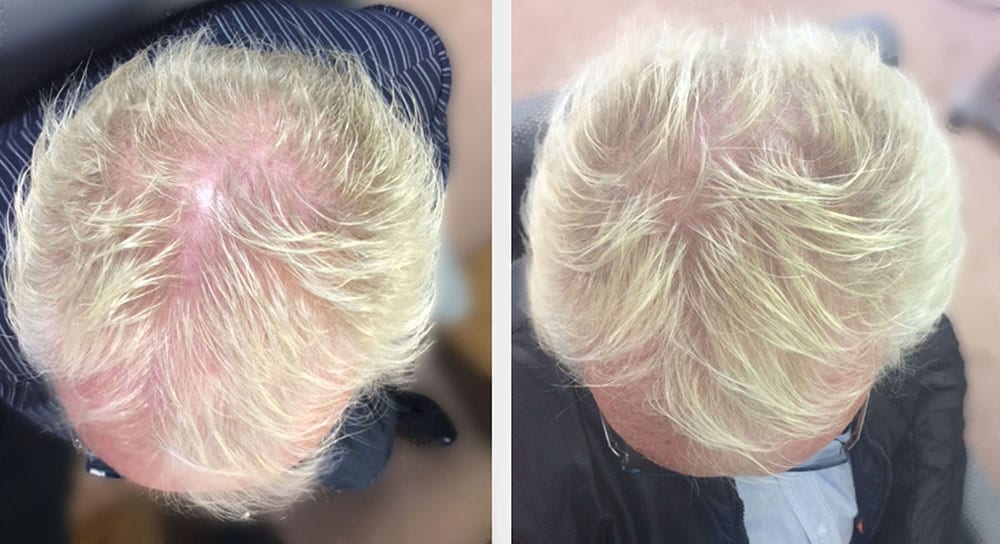 Hair restoration results for James