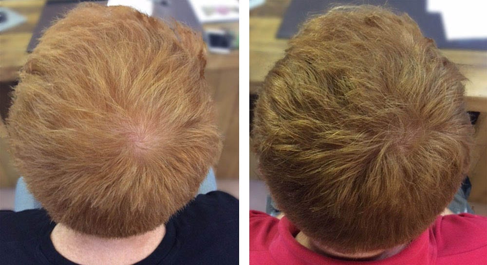 Manchester Hair Restoration Clinic | MHR Clinic UK