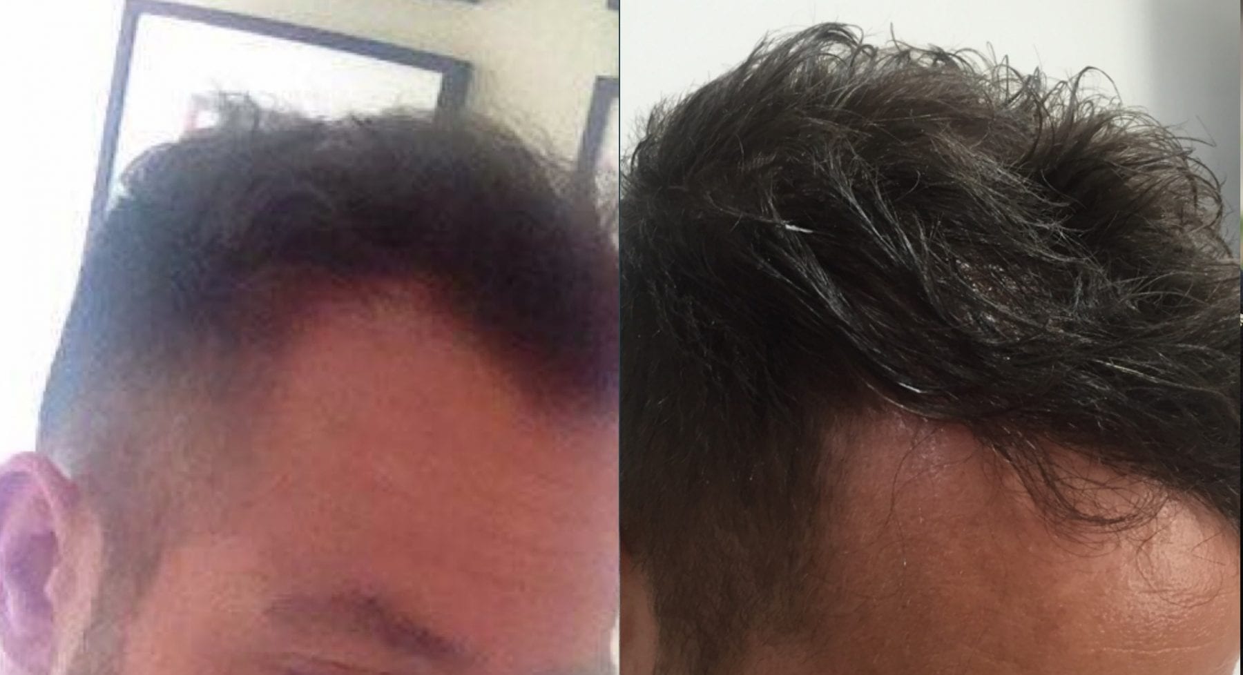 Hair Restoration Results Adam
