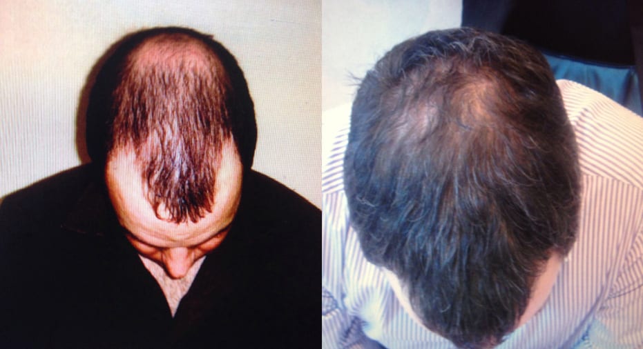 Hair Restoration Results Craig