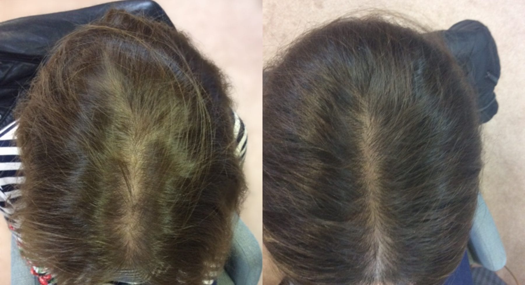 Hair Restoration Results Women Jane