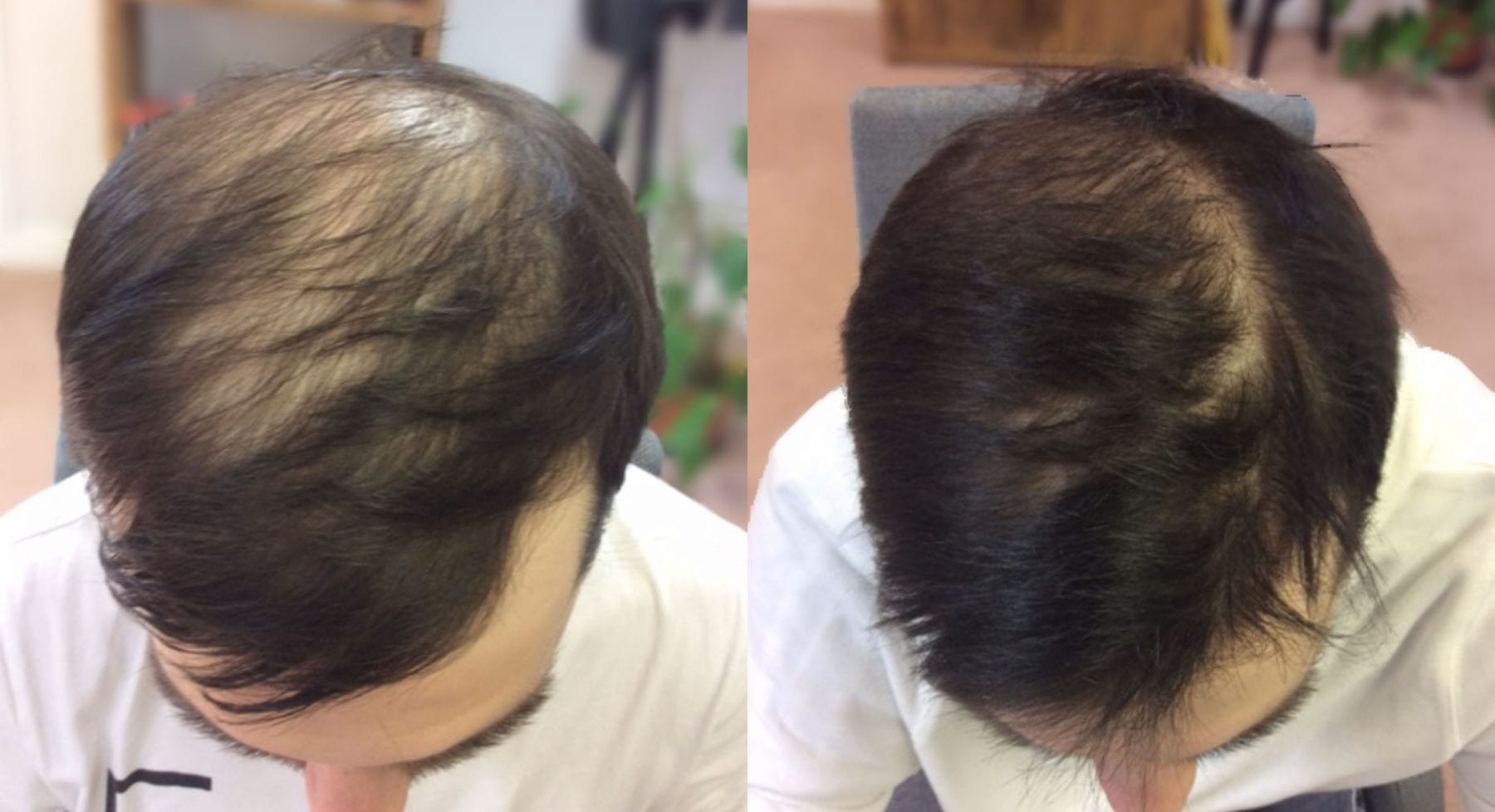 Hair Restoration Results Mr C