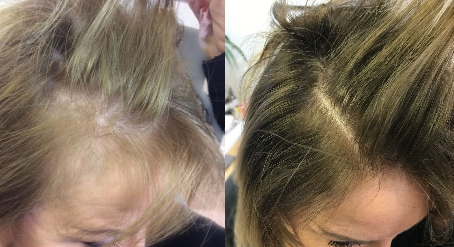 Hair Restoration Women Results Mrs M