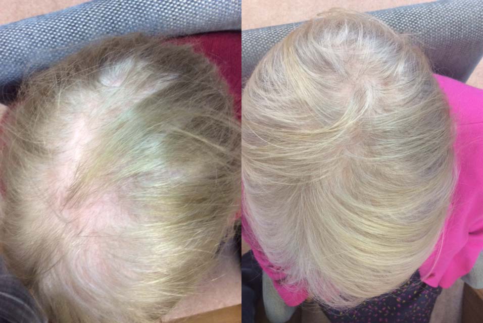 Hair Restoration Women Results Pauline