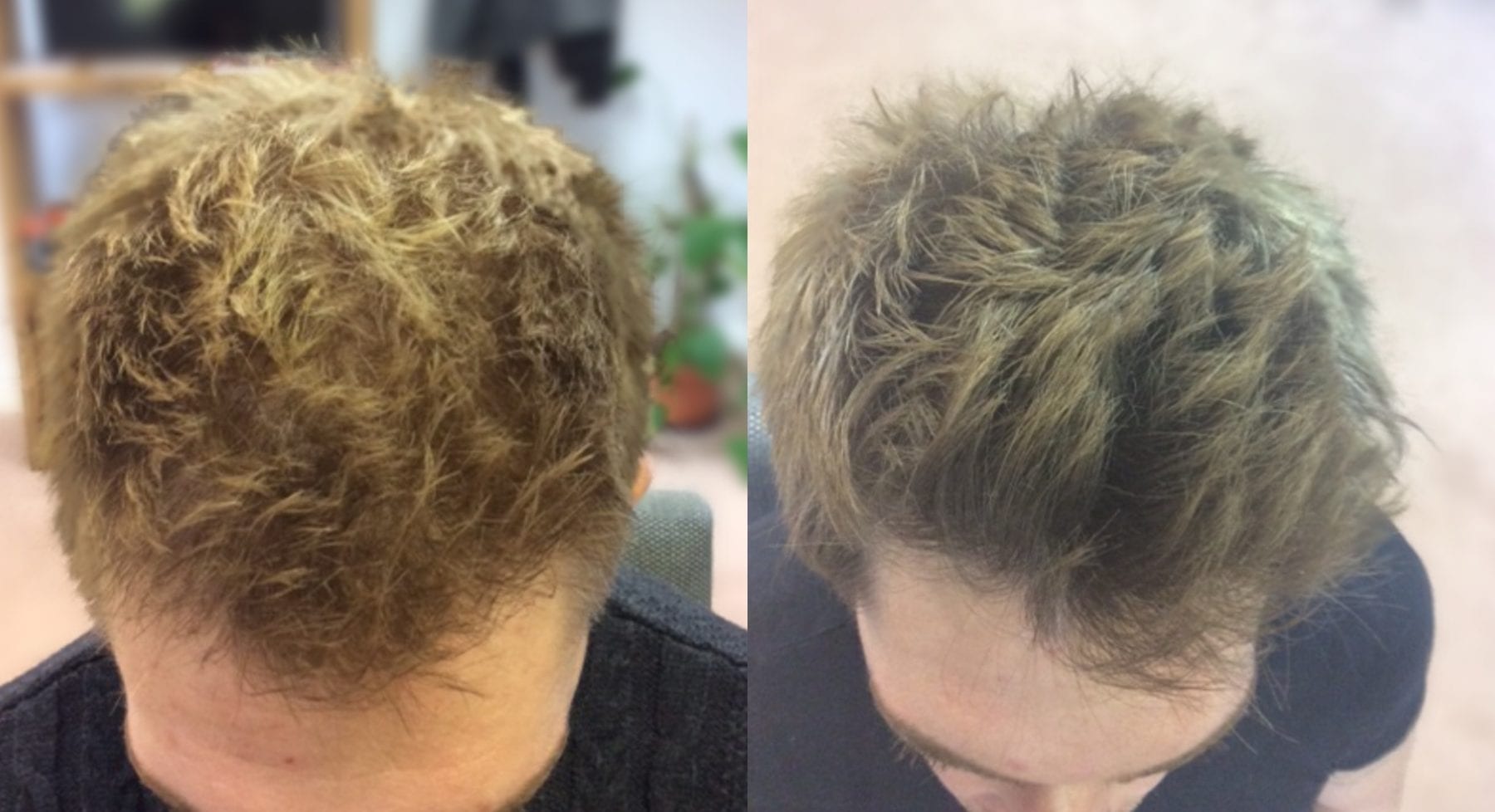 Hair Restoration Results Nick