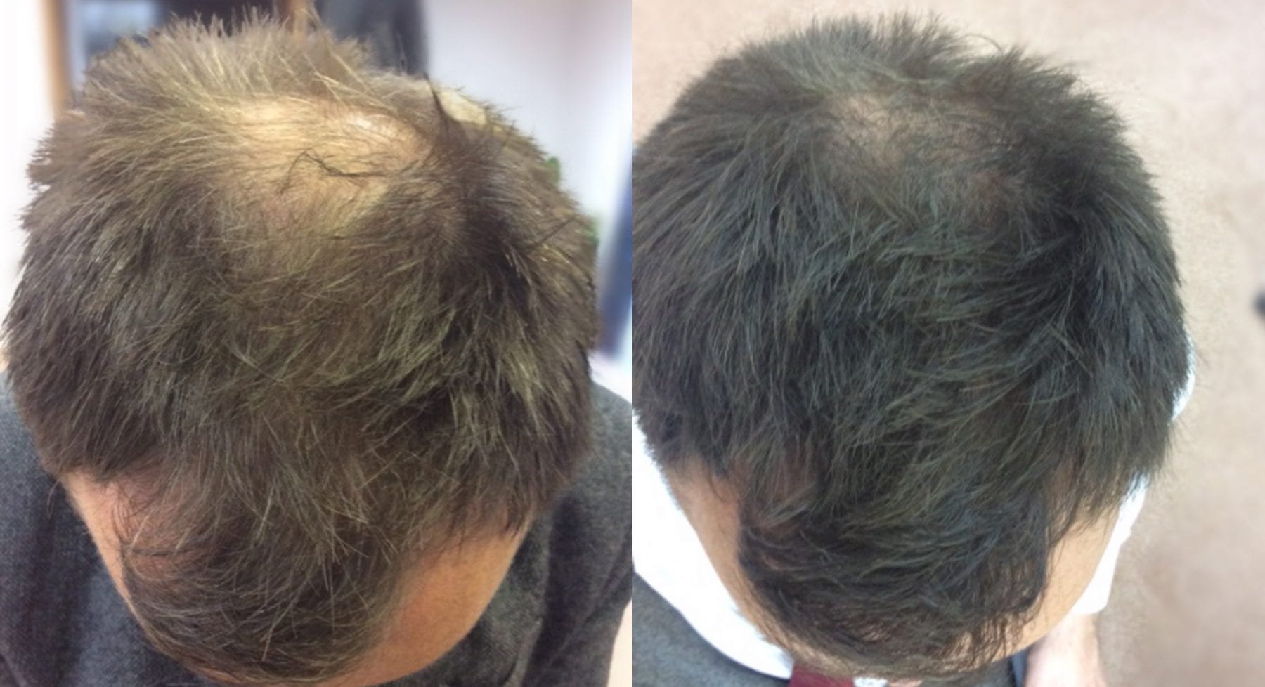 Hair Restoration results Paul