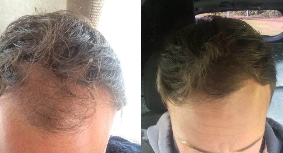 Hair Transplant Results William