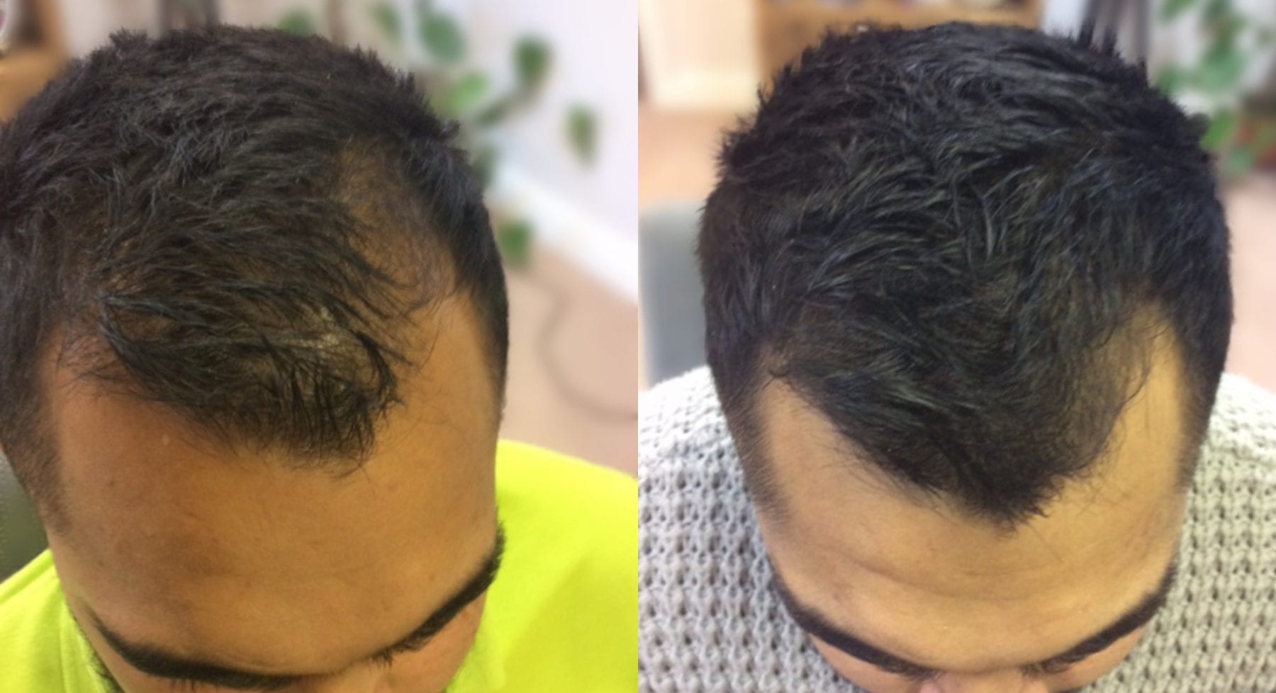 Hair Restoration Results Zaid