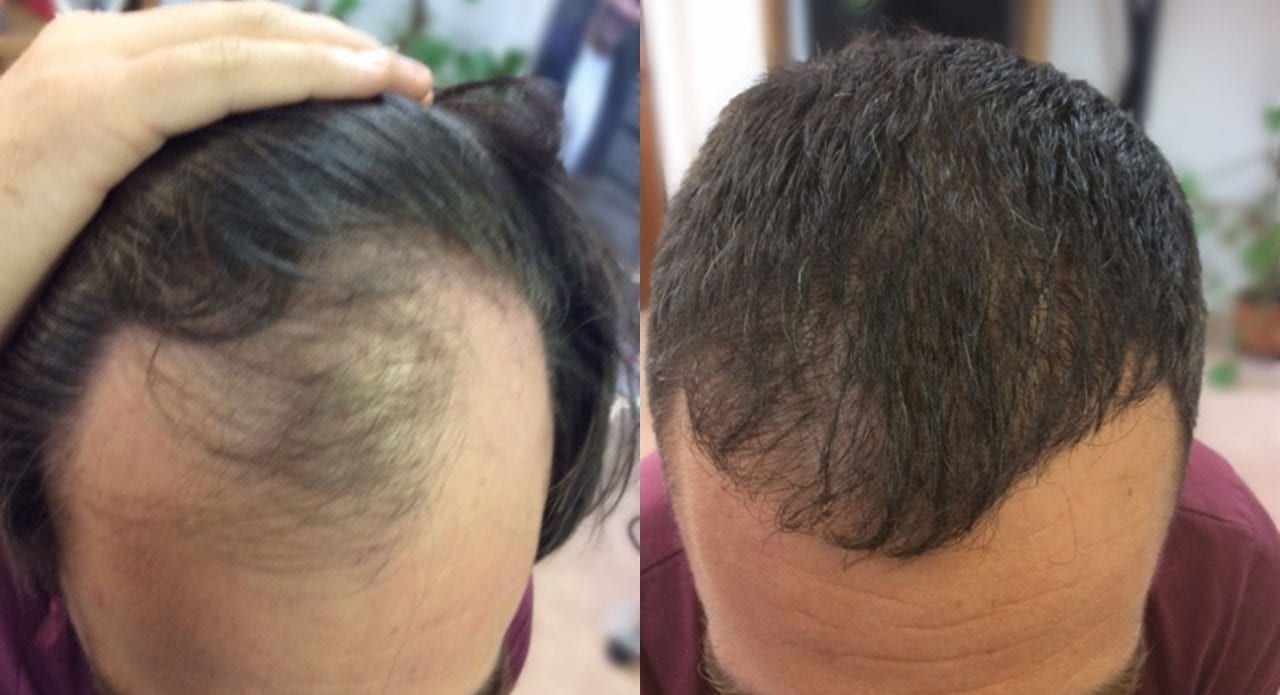 Hair Transplant Manchester MHR Clinic UK Hair Restoration