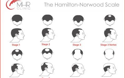 The Hamilton-Norwood Scale of Baldness & Your Hair Treatment