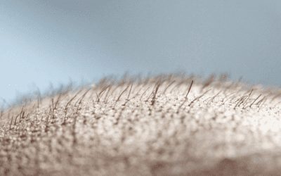 What to expect after a hair transplant