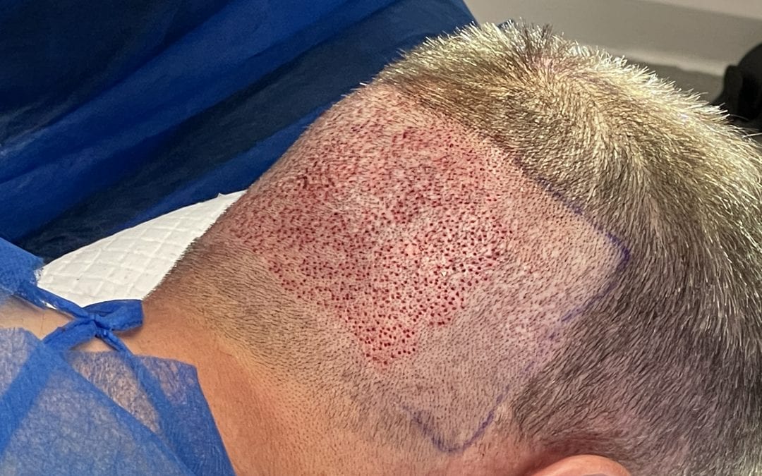 Do FUE hair transplants cause scarring?