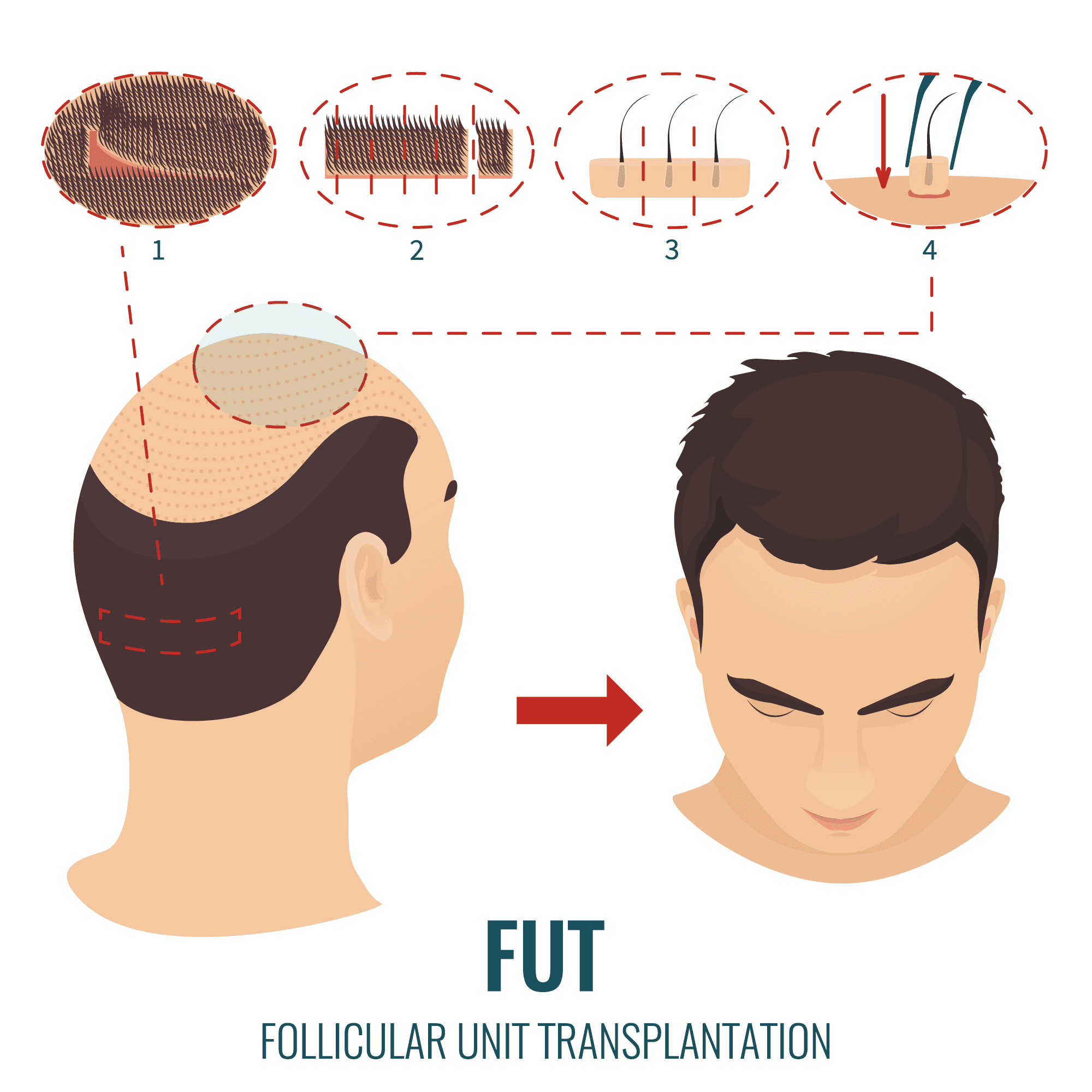 How to heal and conceal FUT hair transplant scars | MHR Clinic