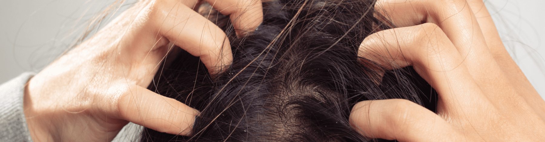 Itchy scalp causes and treatments How to diagnose itching and dandruff