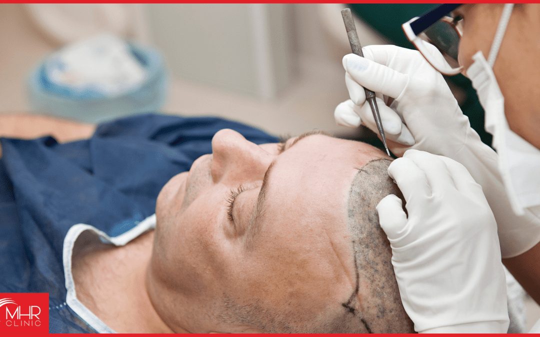 5 Reasons Why A Hair Transplant Abroad Might Not Be The Best Idea.