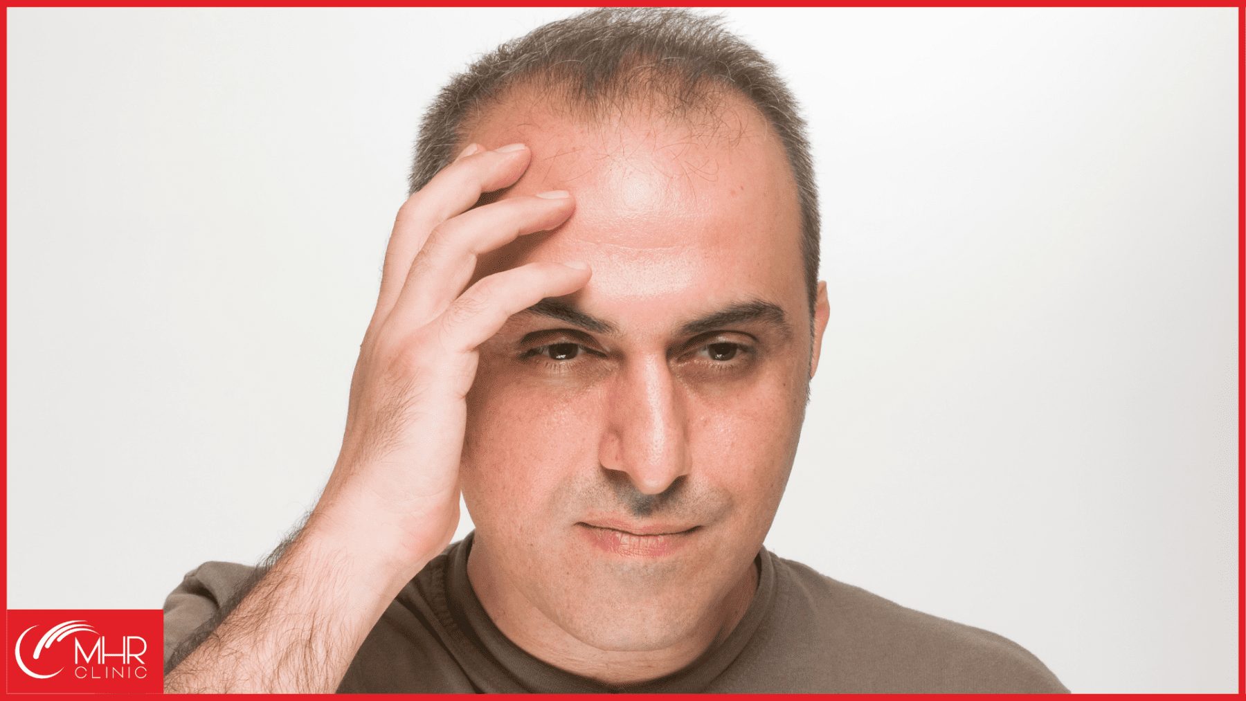 Why balding at 30 years old isn’t uncommon!