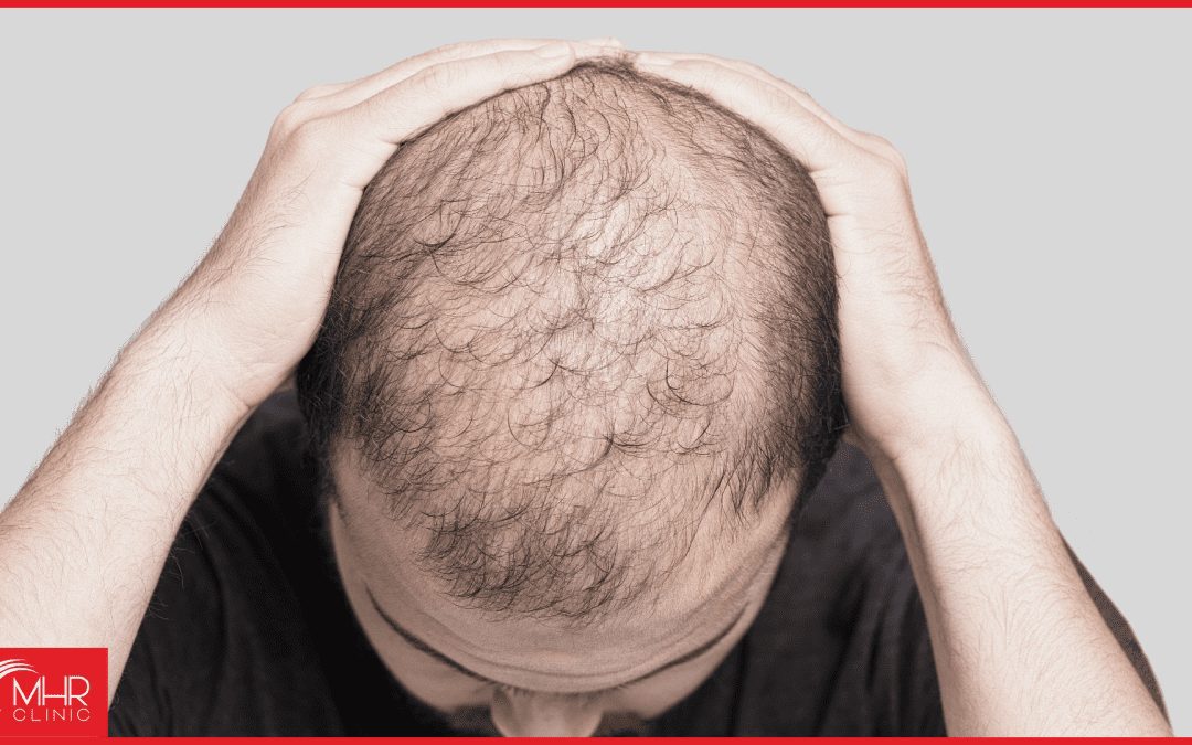 Understanding Balding at 30 Years Old