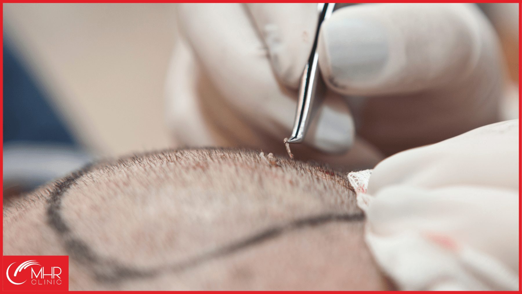 Hair transplant donor area | Everything you need to know.