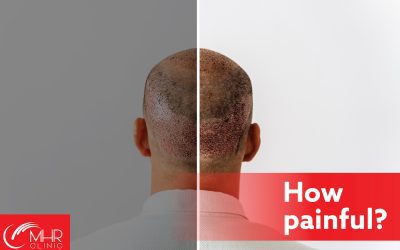 Are Hair Transplants Painful? Debunking the Myths