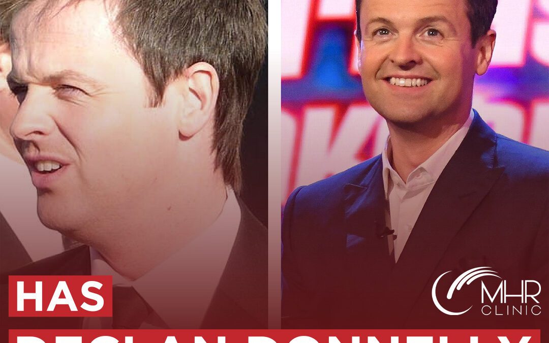 Has Declan Donnelly Had A Hair Transplant?