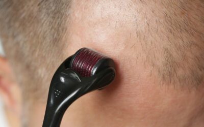 Microneedling for Hair Loss: Is It the Solution You’ve Been Searching For?