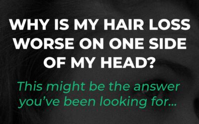 Why Is My Hair Loss on One Side of My Head?