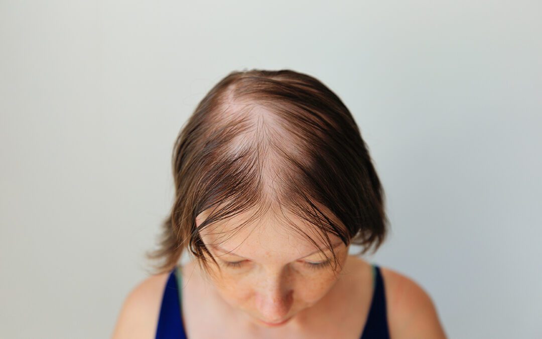 Women’s Hair Loss Causes, Treatment and Options