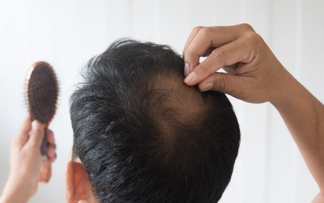 A Clinical Guide to PCOS Hair Loss, DHT, and Permanent Restoration